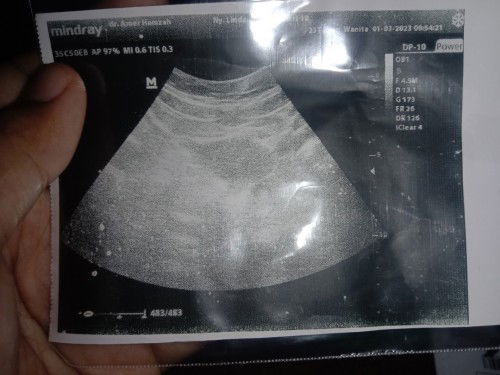 Telat haid 3 bulan,USG ternyata dinding rahim tebal