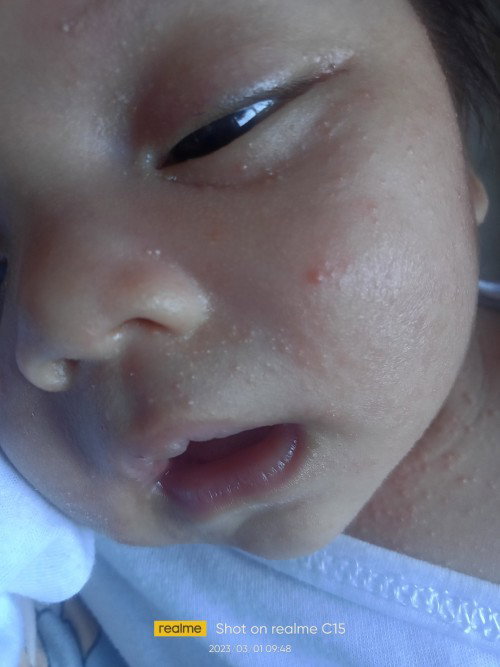 Ano pwede pang gamot sa acne at rashes niya ? Ginwa ko na ung maligamgam na tubig at ung gatas ng in