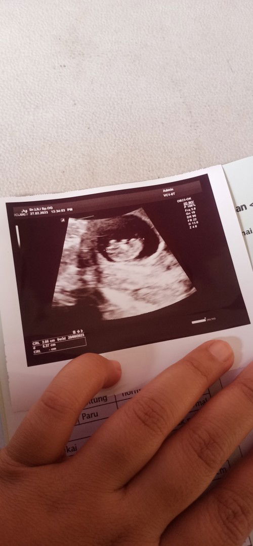 Balik lagi usg kapan bagusnya?