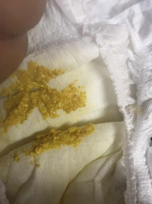 น้อง 20 วันแล้วถ่ายแบบนี้ปกติไหมคะแม่ๆ