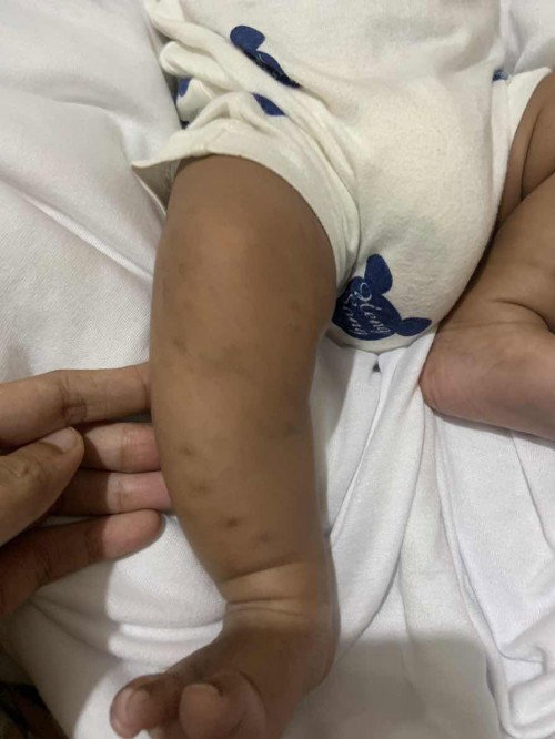 Bintik hitam di kulit
