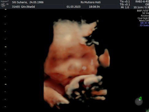 Hasil USG usia 36 week