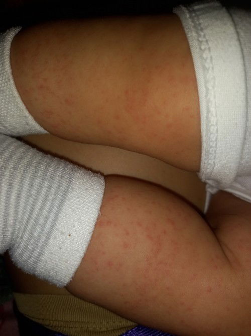 My rashes po legs ni baby