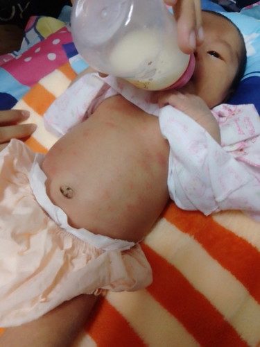 ผื่นขึ้นที่ตัวทารก