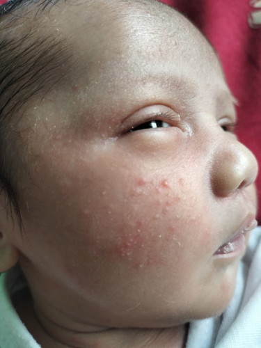 Anu po kayang mabisang gawin para sa baby acne π nagwoworry kase ko para sa face ng baby ko. Salama