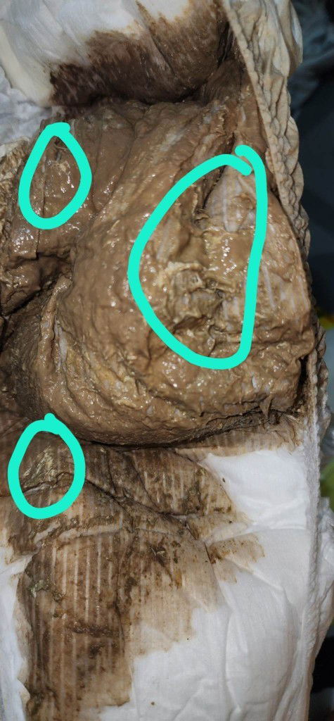 Normal po ba ito or hindi?