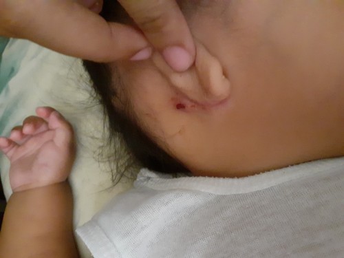 Rash sa likod ng tenga, ano po kaya magandang gamot? Lumabas na po yung absess nya.