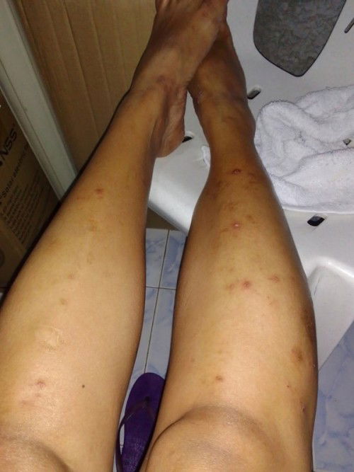 Mga mommies ano po pwede soap ? 
Grabe makati at dumadami lalo maliliit na sugat sa katawan ko :(