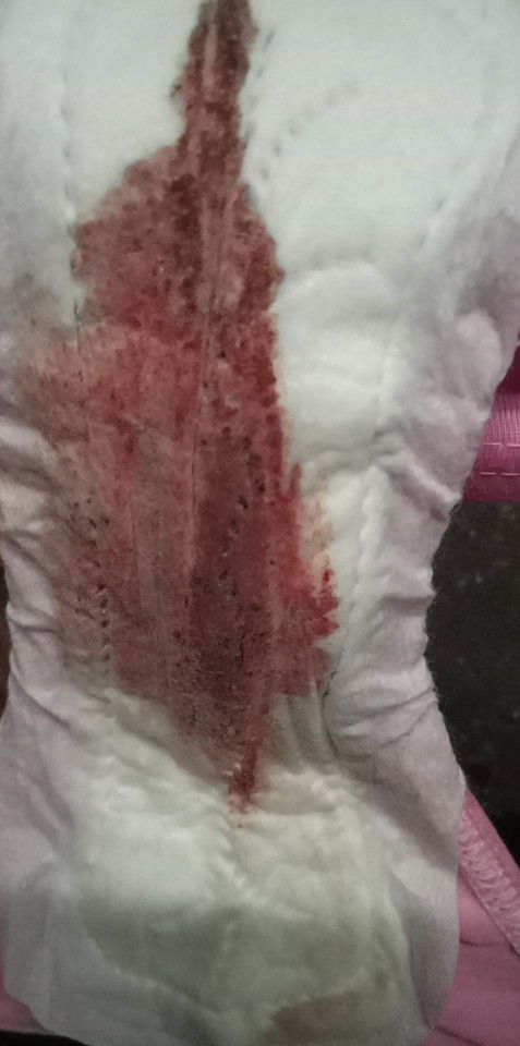 Spotting habang buntis