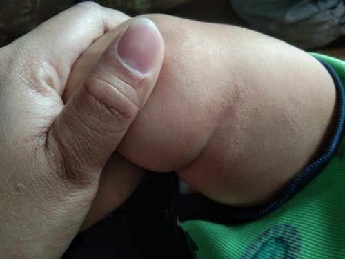 Atopic Dermatitis