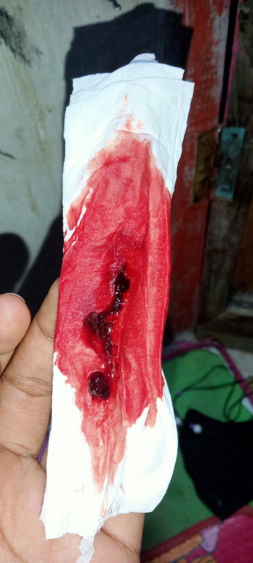 Ada yang pernah ngalamin gak?
Kehamilan 6 Minggu keluar darah udah 3 hari gak berhenti.