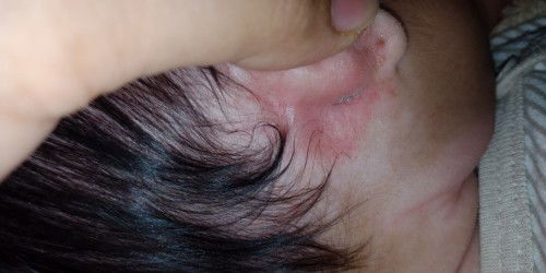 belakang telinga basah dan bau