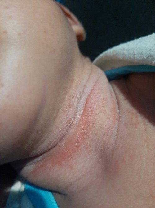 Leher bayi bintik merah