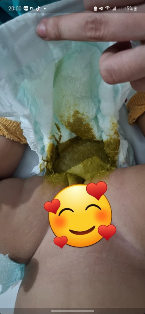 E bé 2m16d đi ị 3 lần 1 ngay có sao không cac mom bé bú sữa ct