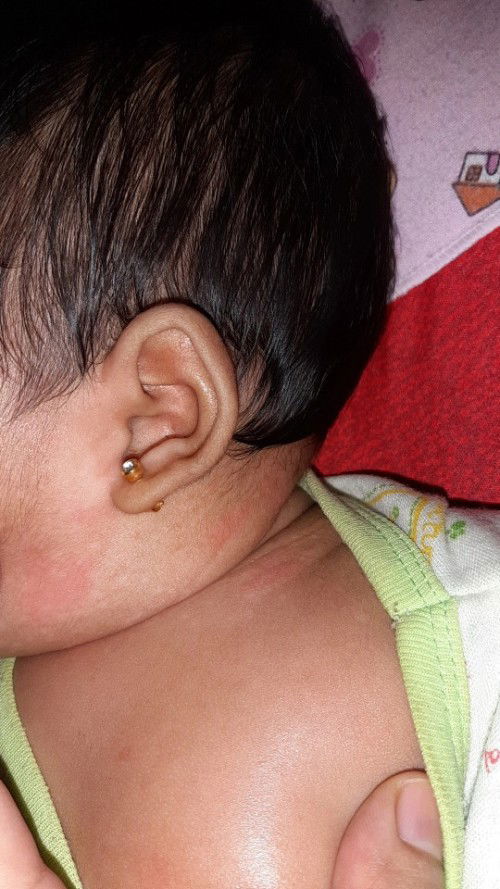 Putih² dan merah² pada kulit bayi