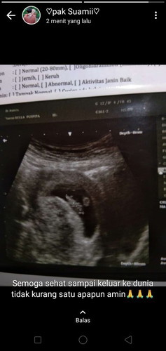 USG pertama masyaallah sehat sehat ya de Di perut bunda :)
