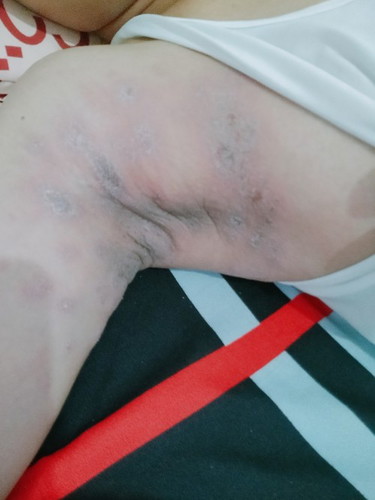 Good morning Po ano Po pwede igamot sa rashes sa kilikili ?