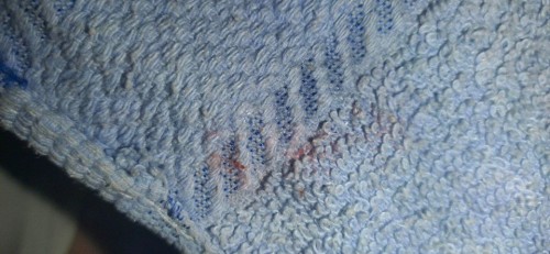 may unting bleeding po