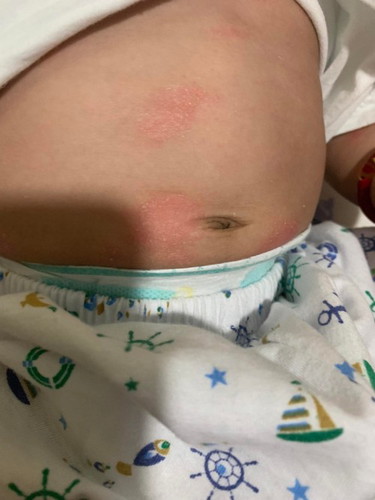 Ringworm or eczema or just an ordinary rashes?