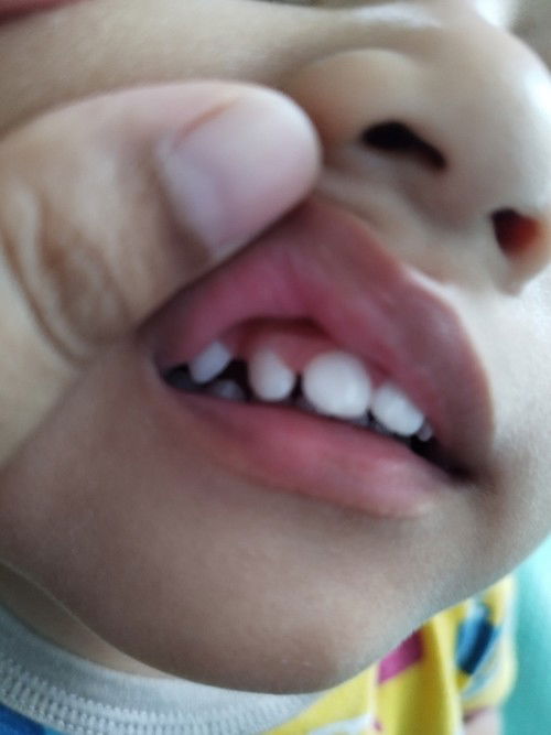 Gusi menonjol dan gigi depan renggang