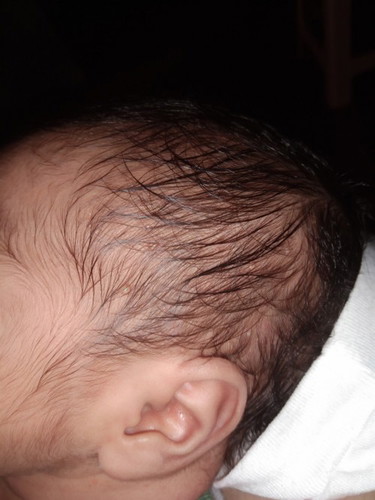 May tumubo po kasing mga parang pimples na ganito sa ulo ni baby