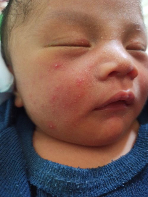 ruam pipi merah" newborn