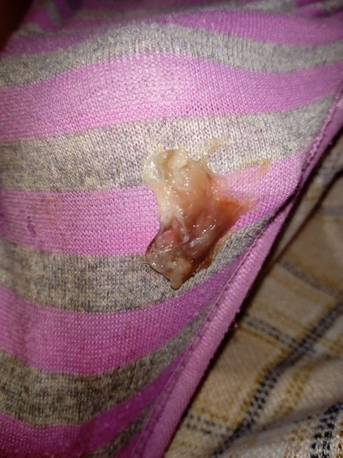 อันนี้คือมูกเลือดใช่ไหมค่ะ ขออภัยด้วยนะคะ อาทิตย์ก่อนปากมดลูกเปิด1 ซม มีโอกาสเปิดเพิ่มไหมค่ะ