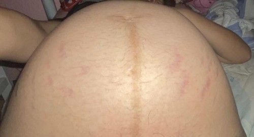 Stretch marks is waving