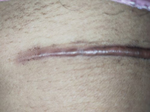 Keloid di bekas jahitan operasi Caesar