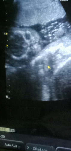 Cleft lip/palate