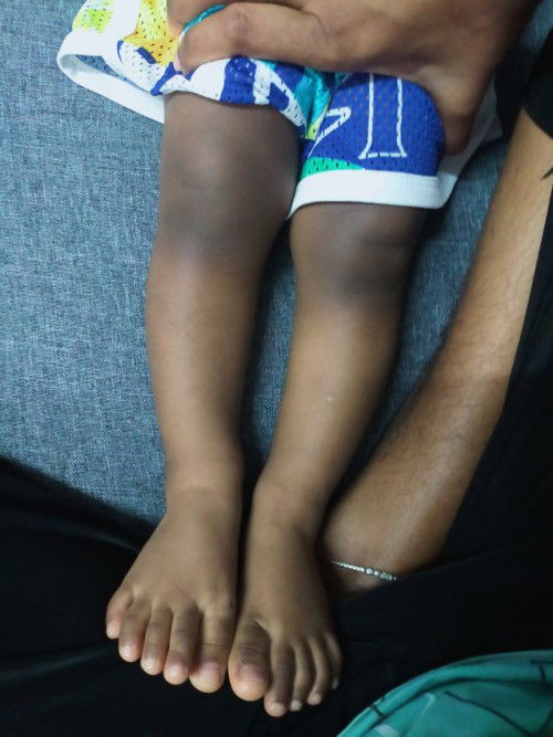 Anak saya 13 bulan baru start jalan xpi saya nampak betis kaki anak Saya macam senget , risau sgt .