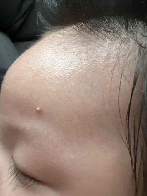 Baby acne with pus