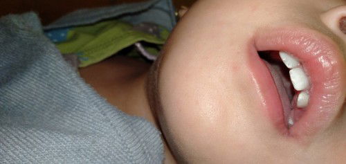 Bercak putih pada gigi anak usia 17bulan