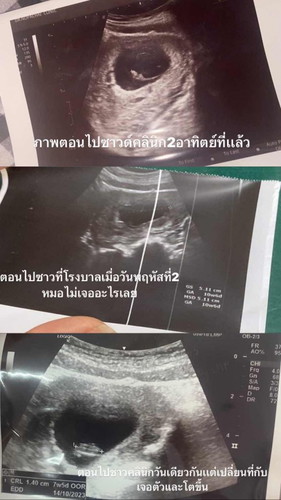 ท้อง11สัปดาค่ะตามหมอบอกเเต่ในใบซาววัดตัวเเล้วได้7สัปดาค่ะ