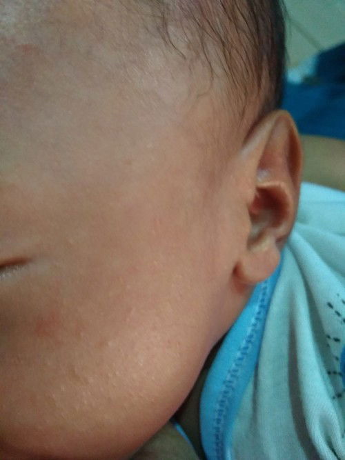 Ada yg prnh ngalamin gk bund, bayiku umur 1 bln muncul beruntusan gini kira" cara ngilanginnya gmn y