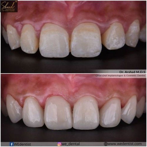 Which Dental clinic offers the best and affordable smile design cost in Coimbatore?