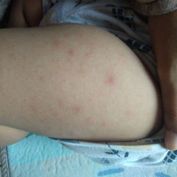Kaki dan tangan bayi ruam merah