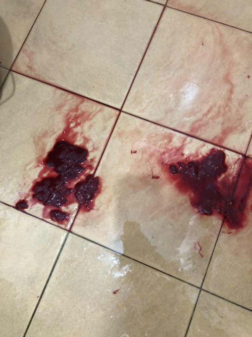 Keluar darah banyak dari anus di UK 18weeks