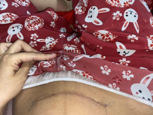 Rút chỉ vết mổ