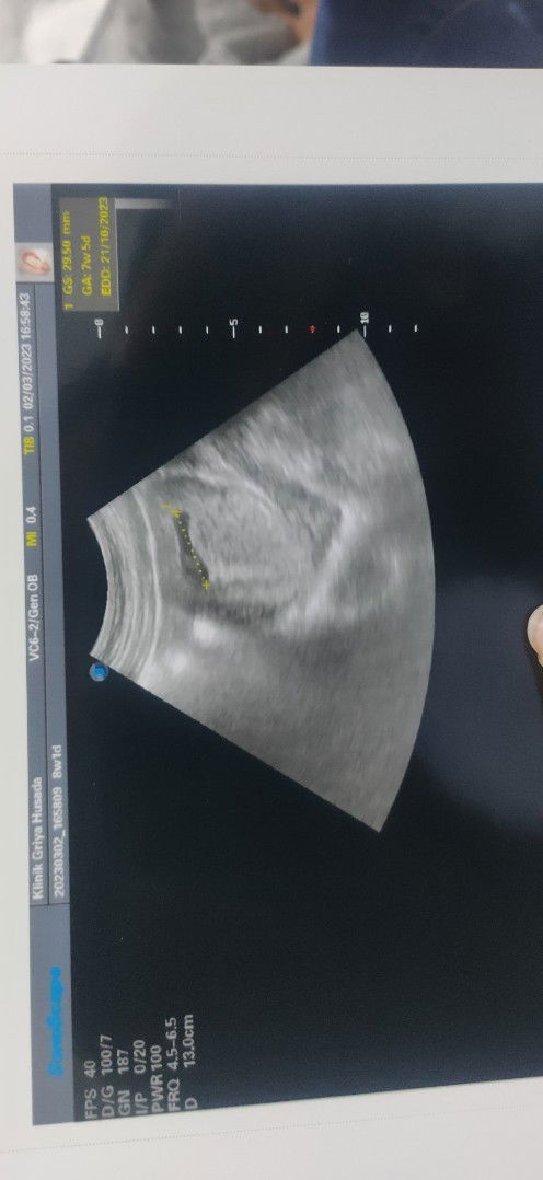 Bun wajar tidk, usia segini kata dr baru kelihatan bakal janinnya.ini USG perut bukan transvaginal