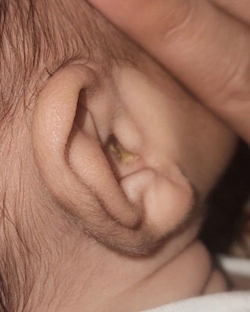 Kotoran telinga bayi