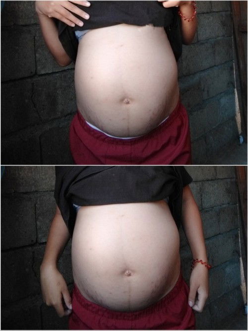 Hi mga Mommies, Normal lang Po ba Ang ganitong tiyan para sa 36 weeks pregnant? Hindi Kasi pantay.😔