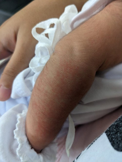 Red spots on newborn's skin