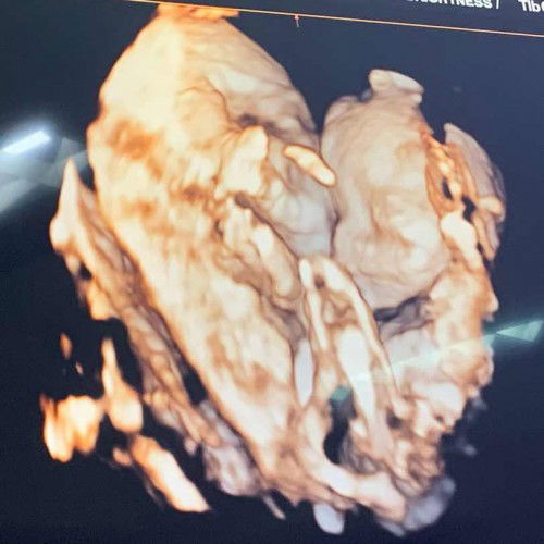 เบาหวานก่อนท้อง กลัวลูกไม่ปลอดภัย