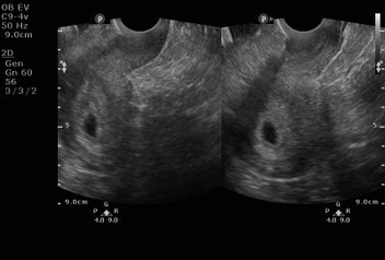 No Embryo seen at the time of Ultrasound