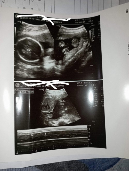 Gender Ultrasound