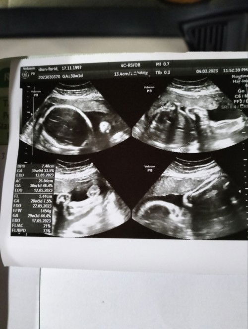 Bayi Sungsang dan berat badan baru 1 kg. Di Usia Kehamilan 30week