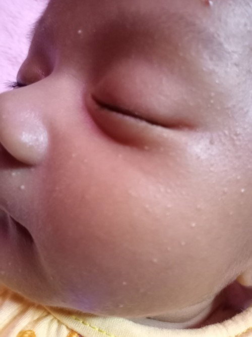 Milia pada bayi