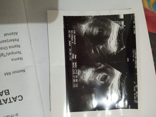 Sedang ada masalah, stress berat, saya punya hipertiroid