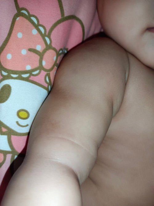 น้อง7เดือน ผิวด่างๆขาวๆแบบนี้ปกติมั้ยคะ